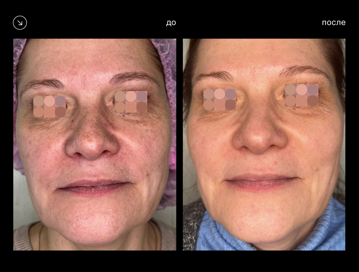 Эффективность аппарата